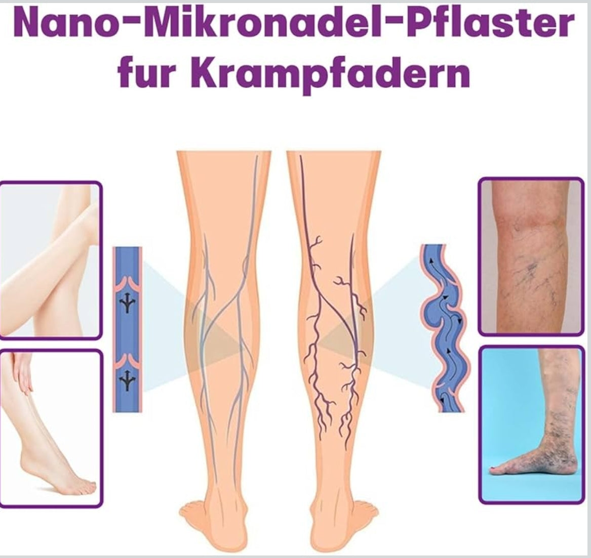 8x POLIDOCANOL-NANO obliži proti krčnim žilam (2x4kom)