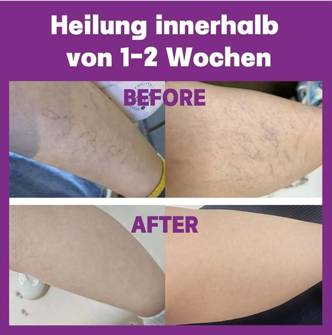 8x POLIDOCANOL-NANO obliži proti krčnim žilam (2x4kom)